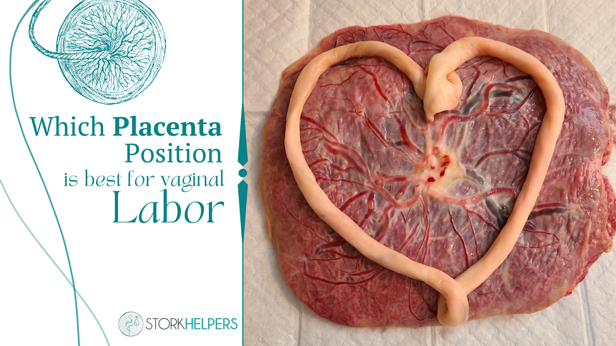 Which Placenta Position is Best for Vaginal Labor? 